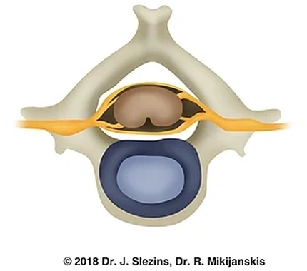 Здоровий міжхребцевий диск шийного відділу хребта