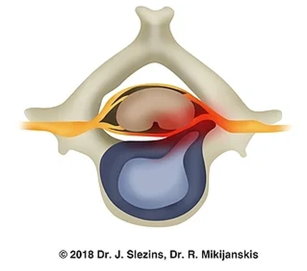 Кила міжхребцевого диска із затисканням нерва, що з нього виходить