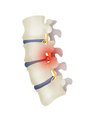 Грыжа поясничного межпозвонкового диска