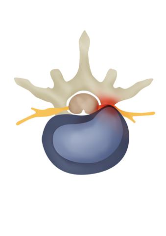 Грыжа поясничного межпозвонкового диска